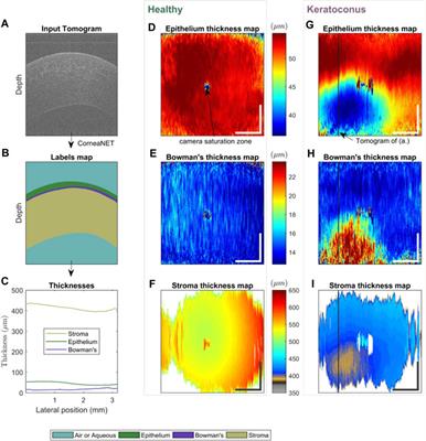 Artificial intelligence-assisted diagnosis of ocular surface diseases